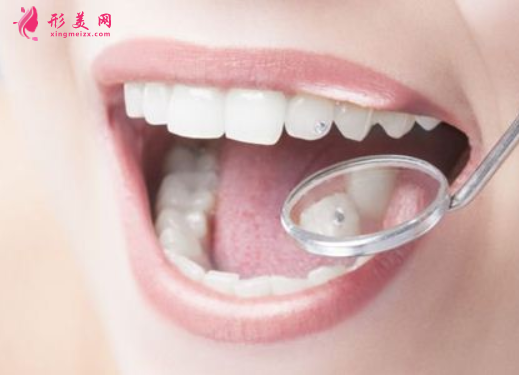烤瓷牙边缘变黑是什么问题