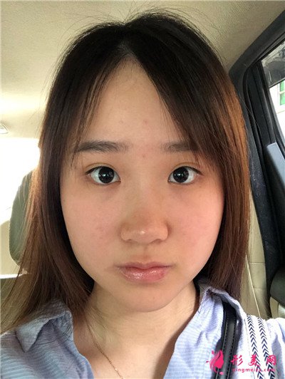 广州鼻综合术后恢复效果展示