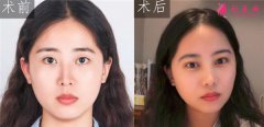 到厦门美莱医疗美容医院做的眼部多项怎么样？真人案例对比分