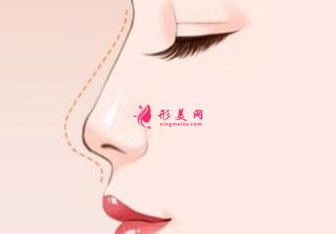 自体软骨隆鼻可以维持多久？