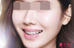 自体脂肪填充脸部有什么优势吗？