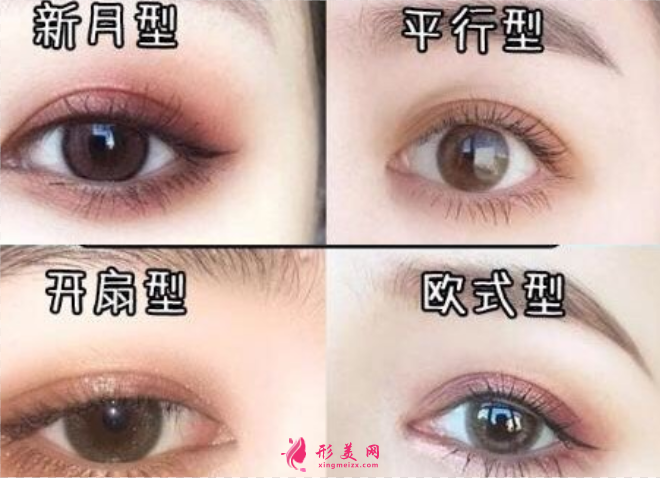 双眼皮术后多少天变得自然