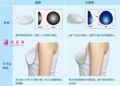 隆胸假体型号哪种比较好？