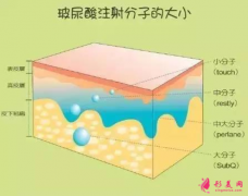 玻尿酸填充脸部效果保持多久？