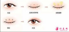 想知道无痕割双眼皮需要多久恢复嘛？小编带你了解！