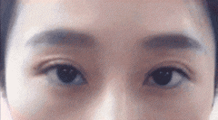 双眼皮修复后要怎么护理