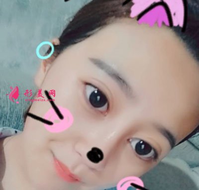 郑州缔莱美医疗美容医院鼻部多项案例
