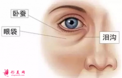 男性眼袋怎么祛除？