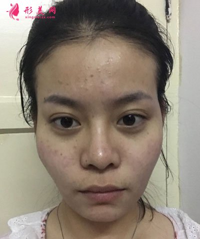 北京纯脂自体做脂肪面部填充怎么样？真实案例分