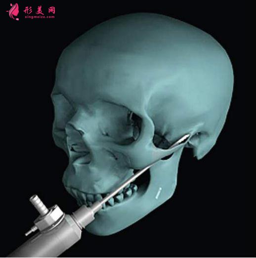 磨骨还是削骨_磨骨还是削骨_磨骨还是削骨