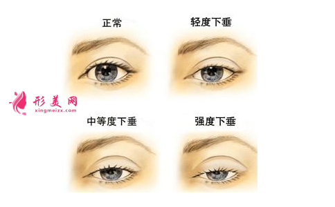 割眼睛皮整形医院-割眼睛皮效果如何