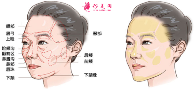 自体脂肪填充面部大约多少钱