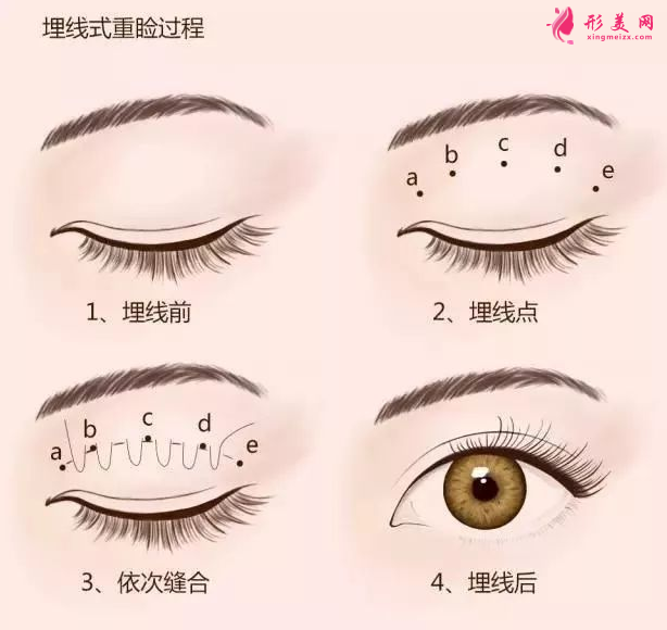 肿泡眼可以做埋线双眼皮手术吗