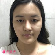 深圳富华医疗美容医院全切双眼皮术后恢复效果对比图分享