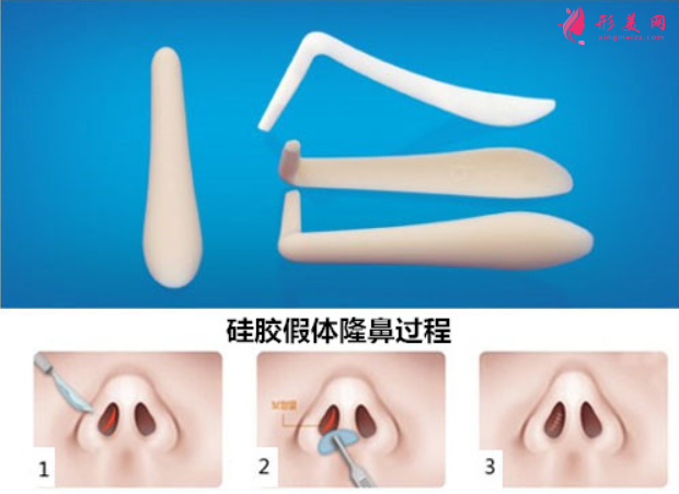 假体隆鼻对人体有害吗