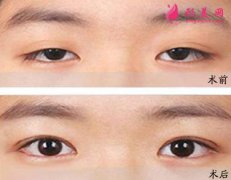 眼睑下垂的种类有哪些？矫正方法及注意事项分享