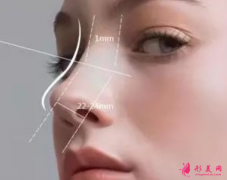 假体隆鼻恢复期要多久？