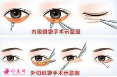 手术祛眼袋大概要多少钱？