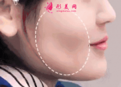 自体脂肪填充脸部一般要注射几次？