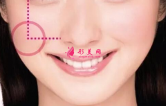 自体脂肪填充脸部会肿多久？