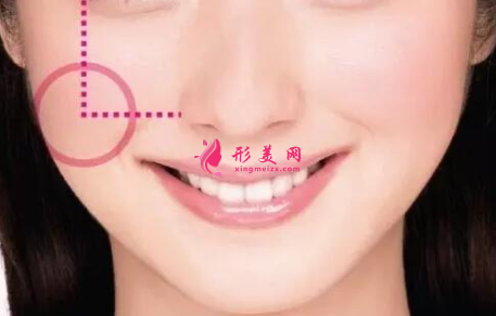 自体脂肪填充脸部会肿多久