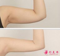 手臂吸脂多久恢复?手臂抽脂需要多久才能恢复?
