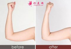 吸脂术后手臂疼痛的八个注意事项