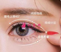 切开双眼皮恢复期一般是多久？