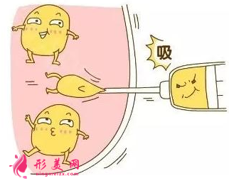 腰腹部吸脂大概需要多少钱