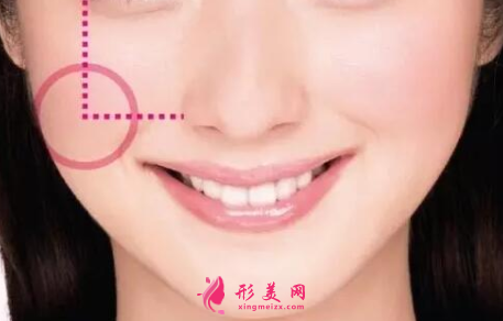 自体脂肪填充脸部费用跟什么有关