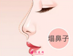 达拉斯隆鼻大概需要多少钱？