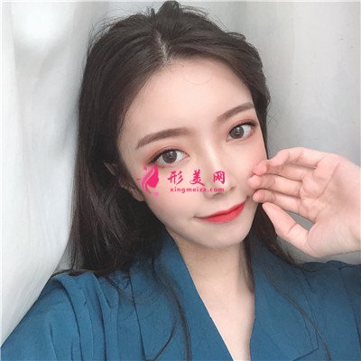 杭州切开双眼皮术后恢复效果反馈