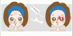 打玻尿酸后多久开始消肿？