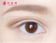 双眼皮术后能保持多久？