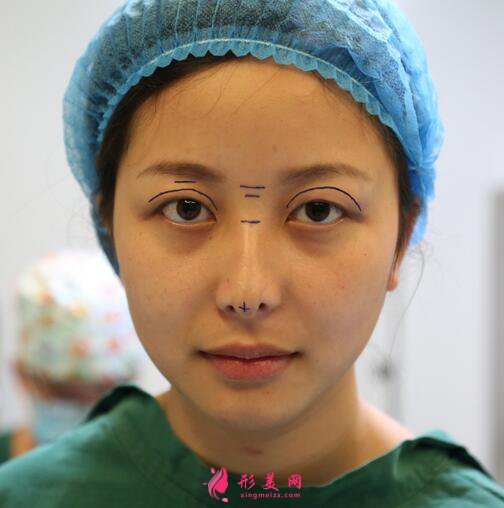 #术前了解#热玛吉除皱能维持多久？效果好不好呢？