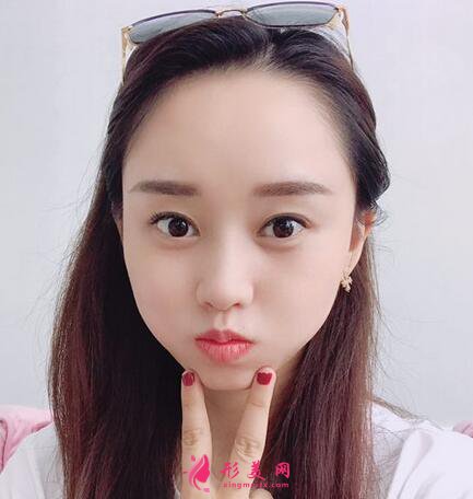 #术前了解#热玛吉除皱能维持多久？效果好不好呢？
