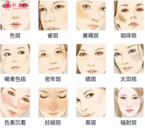 激光祛斑几次能去干净？