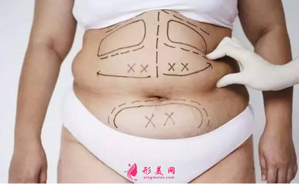腰腹部吸脂要多久恢复好