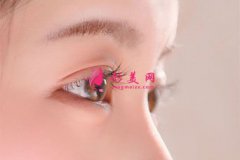 双眼皮失败修复大概要多少钱？
