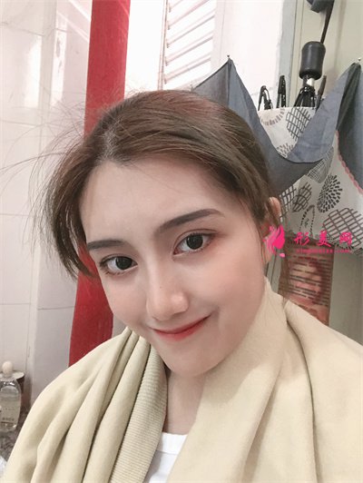 杭州小仙女齐全双眼皮术后恢复情况对比