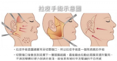 拉皮手术大概需要多少钱?大拉皮和小拉皮手术有什么区别?