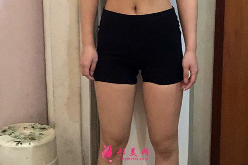 西安大腿吸脂手术后效果分享
