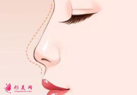假体隆鼻术后的效果好看吗