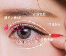 双眼皮术后疤痕跟什么有关？