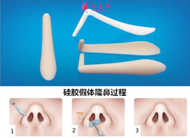 假体隆鼻松动了要取出来吗