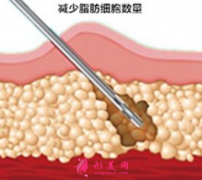吸脂瘦身要多少钱？