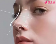 自体软骨隆鼻整形有什么优点？