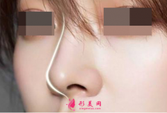 肋软骨隆鼻后多久能恢复
