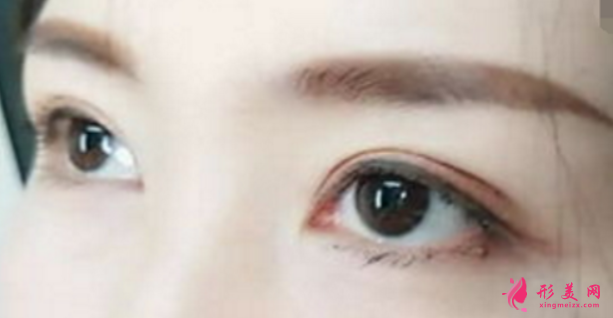 双眼皮手术前要注意的事项