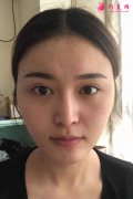 成都哪家医院磨颧骨比较好?成都友谊医院罗恩医生颧骨案例
